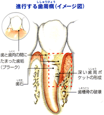 歯周外科とは