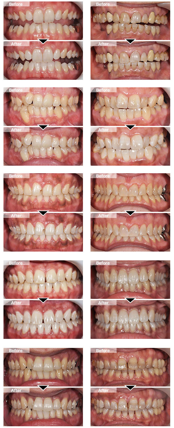 実際の治療例(ホワイトニング)