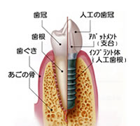 インプラント