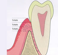 新宿で歯周外科治療